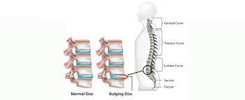 Durerea se resimte diferit in functie de zona care este afectata. VestÄ Pentru Hernia De Disc Move Flex Gel In Romania
