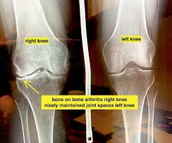 If so, your dr needs to be ashamed of himself. Hip And Knee Arthritis Do Prp And Stem Cell Injections Work The Leone Center For Orthopedic Care