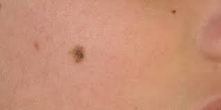 If you aren't sure which type of skin cancer. Atypical Melanocytic Lesions Skin Cancer And Reconstructive Surgery Center
