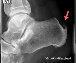 Haglund's deformity is also called haglund's disease and named after the swedish orthopedist patrick haglund. Haglund S Syndrome And How To Solve The Problem