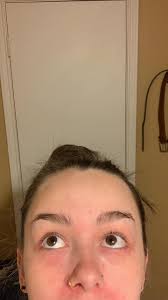 Sunscreen rash treatment options with Neutrogena