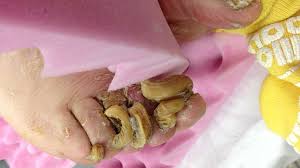 Image result for Onychogryphosis feet