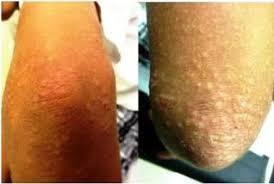 Sexual transmission scabies are passed on through close physical contact. Scabies Timely Diagnosis Key To Containment Relief
