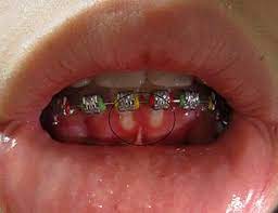 Herpes simplex virus two further conditions, seen especially in children, are herpetic gingivostomatitis and herpetic whitlow. Herpetic Gingivostomatitis Wikipedia