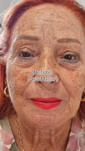 ✨ ¡Dile adiós al melasma con NewMelan del Dr. Eduardo Krulig! ✨ ¿Las  manchas afectan tu piel y tu confianza? Con NewMelan del Dr. Eduardo  Krulig, recupera la belleza natural de tu