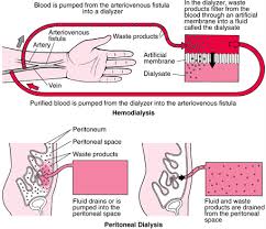 Hemodialysis Compared To Peritoneal Dialysis Peritoneal Dialysis Medical Surgical Nursing Dialysis