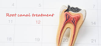 Molar is priced at $800 to $1,500. Root Canal Procedure Who Performs It And What Does It Cost