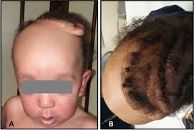 Cutis verticis gyrata and Noonan syndrome: report of two cases with  pathogenetic variant in SOS1 gene
