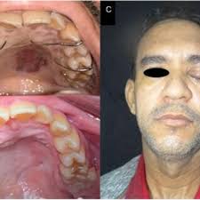 A. Occlusal view of the definitive obturator device installed during...
