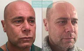 Led therapy has been proven to smooths face fine lines and wrinkles, firms skin, reduces appearance of sun spots and discoloration, calms redness and inflammation. Under Eye Bags Surgery Eye Bag Removal Treatment Lower Blepharoplasty