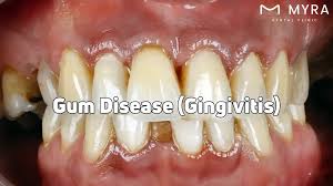 Image result for Gingivitis