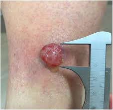 Image result for Merkel Cell Carcinoma