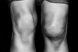 What To Do About Knee Pain Being Caused By Your Unmanaged Or Uncontrolled Type 2 Diabetes Caring Medical Florida