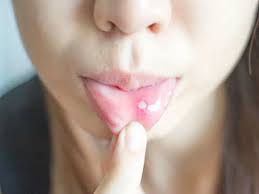 6 Diseases You Can Get By Kissing The Times Of India