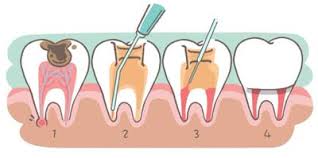 Do you have teeth pain? Root Canals Our Family Dental