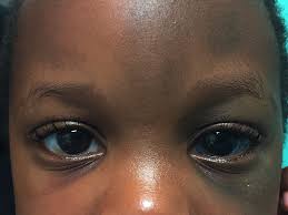 Image result for melanosis sclera