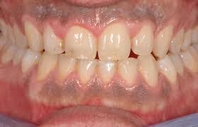 Que Indica El Color De Las Encias Sobre La Salud De Tu Boca Dentistas Teran En Monterrey