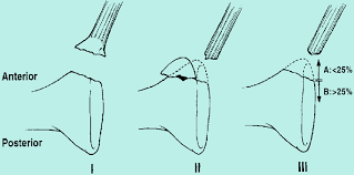 Pattugliatore classe bigliani ormeggiato a messina. Abb 14 Klassifikation Der Glenoidrandfrakturen Nach Bigliani Typ I Download Scientific Diagram
