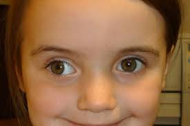 Exotropia Divergent Squint