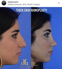 Connect the lines at an angle at the bottom of the nose between the nostrils. Nose Face Patient Gallery Beverly Hills Ghavami Plastic Surgery