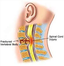 What Is Spinal Cord Injury Spire