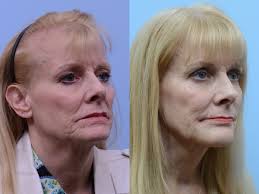 Dr. Thomas J. Hubbard, MD, FACS (@hubbardplasticsurgery) • Instagram photos  and videos