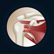 Image result for Rotator Cuff Tendonitis
