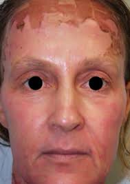 Co2 Laser resurfacing