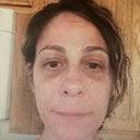 Malcolm A. Lesavoy, MD, FACS, Board Certified Plastic Surgeon