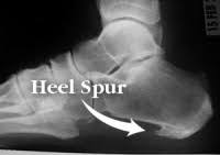 I can't i have bone spurs, they're getting pretty bigly military: Calcaneal Spurs Physiopedia