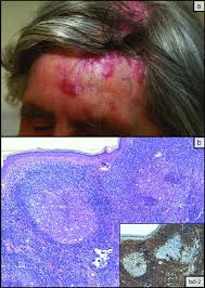 Some types of skin cancer are more dangerous than others, but if you have a spot. Scalp Tumors Prodinger 2018 Jddg Journal Der Deutschen Dermatologischen Gesellschaft Wiley Online Library