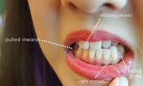 How To Cure Periodontal Disease Naturally Gum Health Receding Gums Dental Health
