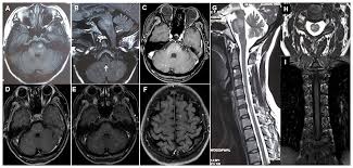 Clippers syndrome (chronic lymphocytic inflammation with pontine perivascular enhancement responsive to steroids) is a recently described rare disease affecting the central nervous system. Frontiers Area Postrema Syndrome A Rare Feature Of Chronic Lymphocytic Inflammation With Pontine Perivascular Enhancement Responsive To Steroids Neurology
