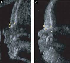 Most ultrasound findings seem to be equally predominant in trisomy 18 or 13, with the exception of defects in the urogenital tract, which we only found in foetuses with trisomy 13. Ultrasound Images Of A Normal Fetus A And A Fetus With Trisomy 21 B Download Scientific Diagram