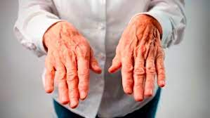 Essential tremor is a nerve disorder that causes shaking that you can't control in different parts and on different sides of your body. Temblor Esencial Una Condicion Mas Comun De Lo Que Se Cree Y Que Puede Ser Tratada Sin Incision Con Gamma Knife Portal Red Salud