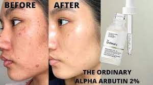 If using the ordinary alpha arbutin and the ordinary niacinamide, which one goes first? The Ordinary Alpha Arbutin 2 Ha Review Before After 6 Weeks Youtube
