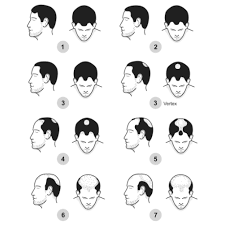 A horseshoe shape is now prominent along with the remaining hair that exists on the side of the head. The 7 Stages Of Male Pattern Baldness Explained Skalp