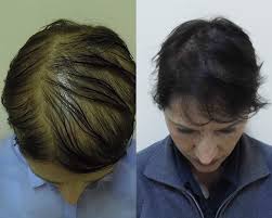 Meiden sie frisuren, die einen zug auf das haar ausüben. Micro Hair Tattoo Vorher Nachher Bilder Prohaarklinik