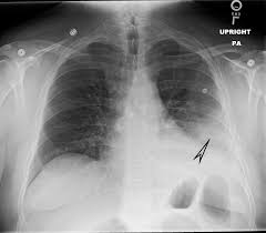 Positioned with the affected side down on the. Cureus Hemorrhagic Pleural Effusion A Rare Presentation Of Vitamin K Deficiency In An Adult Patient