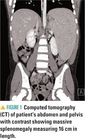 Particularly where the spleen is located. Massive Splenomegaly In A 6 Year Old Girl Contemporary Pediatrics