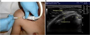 Image result for Subacromial Space Injection