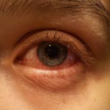 Image result for Viral Conjunctivitis