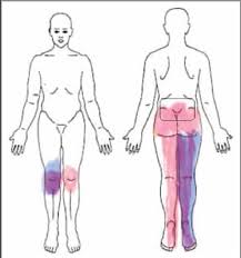 Image result for Paresthesia