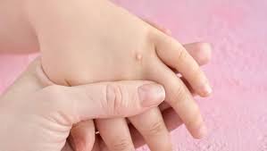 Selengkapnya di d'academy asia 2, the real voice from asia! Kenali 6 Jenis Kutil Yang Sering Dialami Balita Buah Hati Moms Mengalaminya Orami