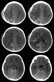 Pembekuan darah merupakan hal biasa yang terjadi jika seseorang mengalami luka atau goresan hingga melukai kulit. Kesan Sampingan Ct Scan Kepala Ct Scan Machine