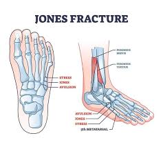 Image result for Foot Fracture