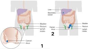 Some of the early warning signs of liver cancer include: 5 Early Warning Signs Of Anal Cancer That You Shouldn T Be Embarrassed To Talk About Women Daily Magazine