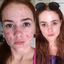 Its high fat content, proteins, and vitamin e nourish the hair from roots to ends, helping to restore thinning hair, split ends, and chemical and heat damage. Pin On Acne