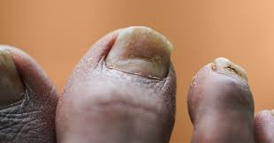Image result for Pitting nails feet