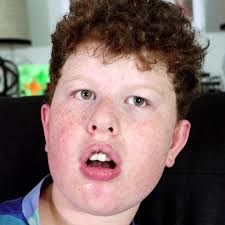 William is diagnosed with Treacher Collins syndrome and his sister, Mari,  is autistic. They were both adopted at a young age and are now siblings and  best friends. Mari translates for her